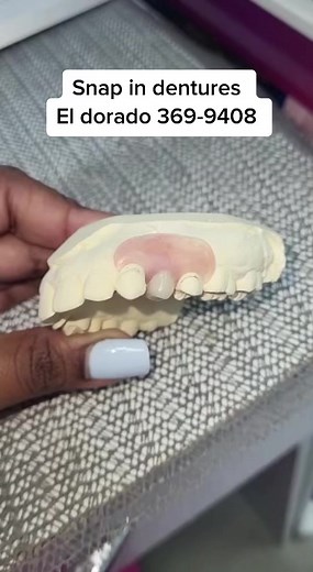 Single tooth snap in denture ready for our lovely patient 🥰 #trinidaddentist #trinidadandtobago #dentures #snapindentures #flexibledenture #teethreplacement #implants #dentalimplants #dentalbridge