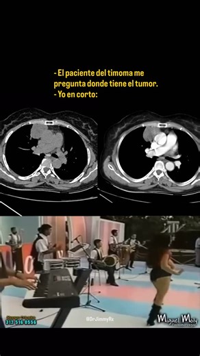 Mejor explicado imposible. 📌El timoma es un tumor epitelial que se origina en el timo, ubicado en el mediastino anterior. Es el tumor primario más común de esta región en adultos. 👁️‍🗨️ Suele ser de crecimiento lento y muchas veces se detecta como un hallazgo incidental en estudios de tórax. 🩻En estudios de imagen se presenta típicamente como una masa bien delimitada, de contornos lisos, y puede contener septos o calcificaciones. En casos más avanzados puede infiltrar el pericardio, pleura o