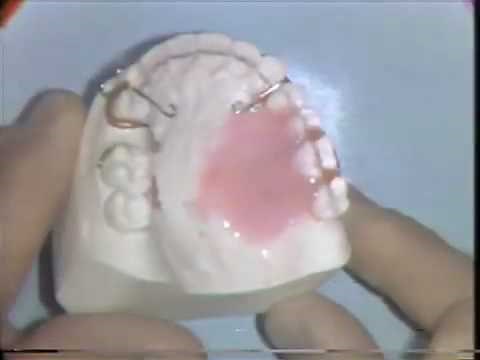 Orthodontic Acrylic Technique
