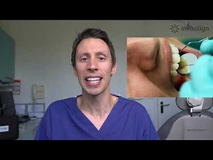 Invisalign - Patient Walkthrough with FULL DETAILS and procedure