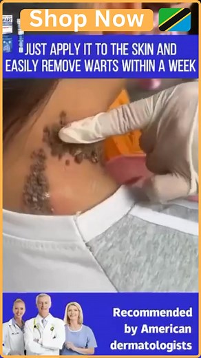 16 reactions · 4 comments |  Sema bye-bye kwa Warts & Skin Tags —...