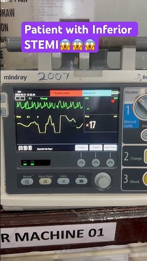 Patient with inferior STEMI😱😱 #cardiology #ecg