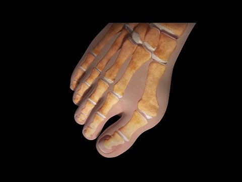 What Are Bunions and When to Seek Treatment - CHI Health