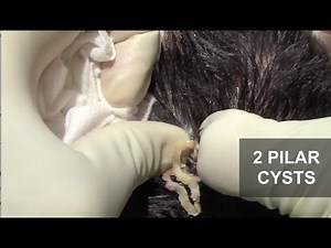 2 Pilar Cysts | Dr. Derm