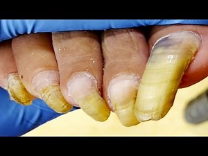 I Have Super Long Toenails, How Do I Wear Shoes Like This【Podiatry Clinic】