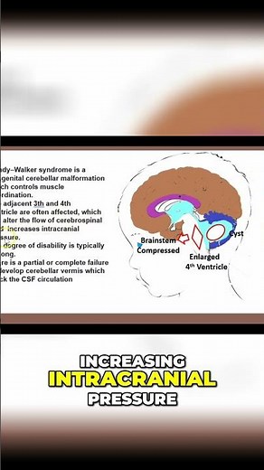 Dandy-Walker Syndrome: Causes, Symptoms, and Treatment #shorts