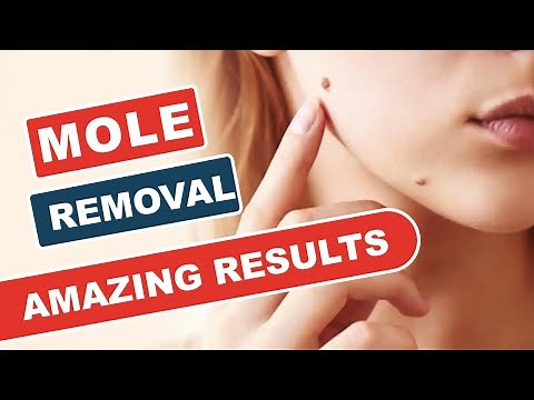 Laser Mole Removal Before & After| Best Doctor for Mole Treatment | Mole Removal Surgery | SkinQure
