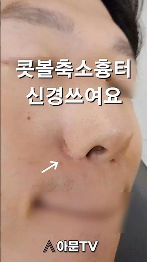 콧볼축소 흉터 레이저 및 주사 후기 (성형수술 레이져 병원 성형외과 서울 scar laser)[아문TV]
