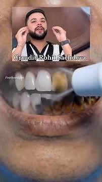 DIY Teeth Whitening Remedy 😱 Remove Yellow Teeth Naturally at Home | Inspired by Rohit Sachdeva