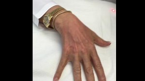 A Doctor Demonstrates PicoSure Laser for the Hands