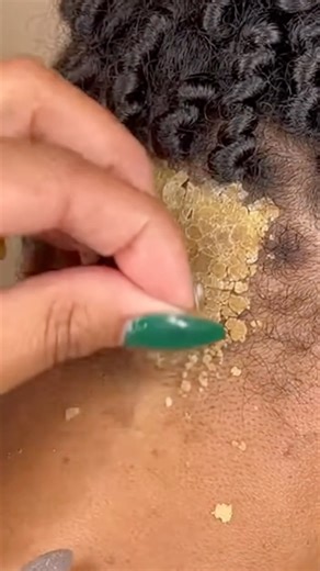 The ultimate skin peeling ASMR 👂✨ #satisfying #scalpcare #asmr #dandruffremovals #oddlysatisfying | Kabar Viral Videos