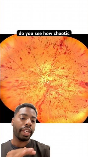 How CRVO (central retinal vein occlusion) affects the eye!