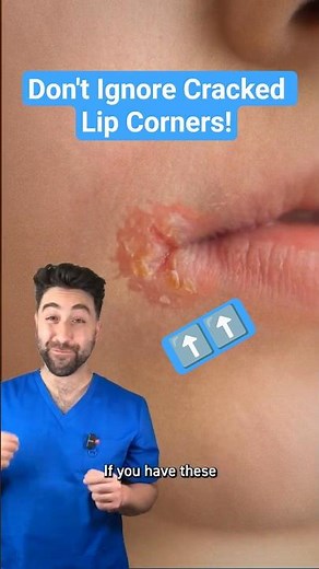 Don't Ignore Cracked Lip Corners!