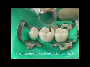 Class II Inlay cavity preparation