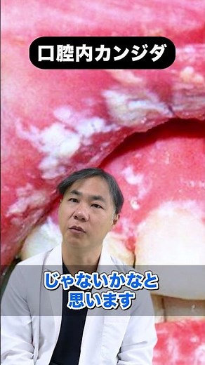 口腔内カンジダに注意