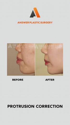 Protrusion Correction Surgery: Refine Your Look and Impression
