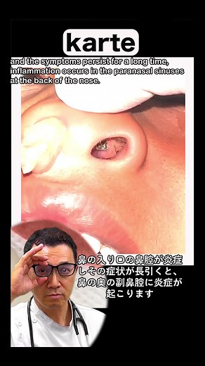 異物が鼻の中に詰まっている可能性と副鼻腔炎の症状解説