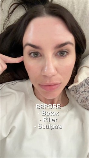Before and after Botox, filler, and Sculptra