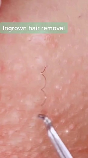 #greenscreenvideo #pimplepopping #extractions #acnepopper #acne #pimplepopper2021 #ingrownhair Oh my..