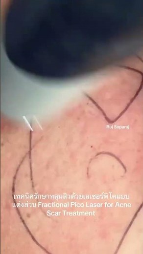 เทคนิครักษาหลุมสิวด้วยเลเซอร์พิโคแบบแต่งส่วน Fractional Pico Laser for Acne Scar #รักษาหลุมสิว