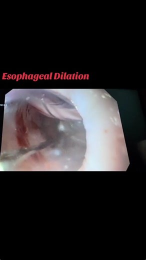 Opening a Stricture During EGD #GIHealth #Endoscopy