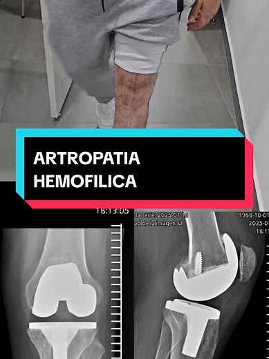 Prótesis de Rodilla por Artropatía Hemofílica