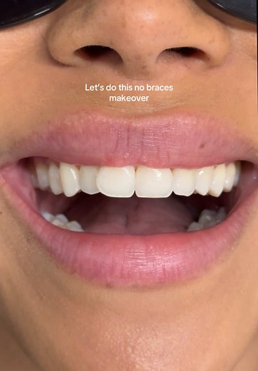 Composite Veneer Makeover for Misaligned Teeth