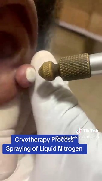 Effective Cryotherapy for Keloid Removal