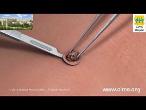 Skin Biopsy - CIMS Hospital