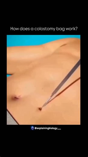 BIOLOGY | MEDICAL | HEALTH ⚕️ | How does a colostomy bag work? A colostomy is when the intestine is brought out through an opening in the abdomen, called a stoma. Instead... | Instagram