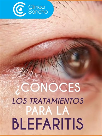 👁️ La blefaritis no suele ser una enfermedad grave, pero puede causar molestias, irritación y afectar tu calidad de vida si no se trata a tiempo. En Clínica Sancho te brindamos una evaluación especializada y el tratamiento adecuado. 📞 Agenda tu cita y cuida la salud de tus ojos. #Blefaritis #SaludVisual #CuidamosTusOjos #Oftalmología #OjosSanos #ClínicaSancho | Clínica Sancho