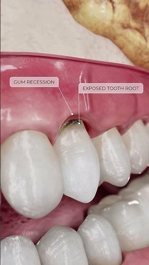 What are root caries? How do they affect your teeth?