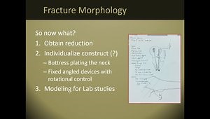 Open Plate Reduction for Pauwels Fractures