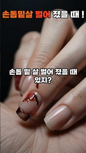 손톱 "살" 벌어졌을때! #shorts #이슈 #지식