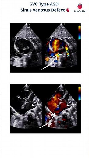 SVC Type ASD | Sinus Venosus Defect 🫀 #heartdisease #echocardiography #cardiologyeducation