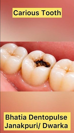 Tooth cavity? Make the tooth normal again! #cavity #tooth #filling