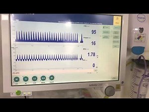 Workshop 38 to adjust settings (MAP) of HFOV? How to adjust Alarm in HFOV? High frequency