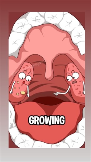 healthmanager11 on Instagram: "What are those smelly particles that you pick out of your throat?#animation #funny #shorts #webtoon #trendingreels"