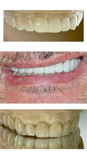 Treatment plan wax up, Temp and final Lab’s ceramic work!