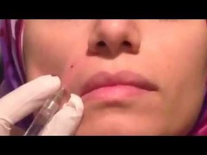 Dermal Filler Injection into nasolabial folds