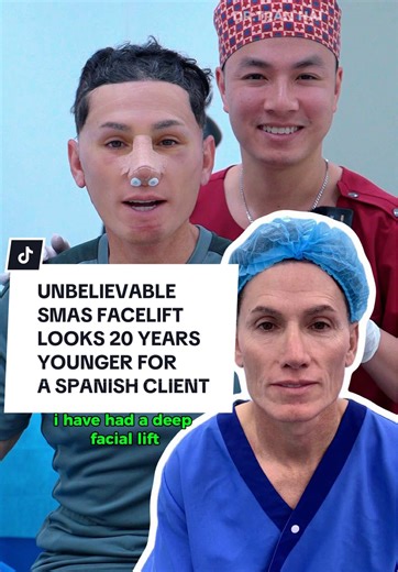 Transformative SMAS Facelift Results for Spanish Client