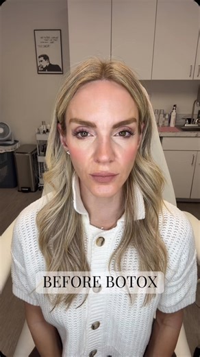 𝖡𝖤𝖠𝖴𝖳𝖸 𝖢𝖴𝖫𝖳𝖴𝖱𝖤 𝖬𝖤𝖣𝖲𝖯𝖠 - 𝖩𝖤𝖲𝖲𝖨𝖢𝖠 𝖢𝖧𝖱𝖨𝖲𝖳𝖸, 𝖯𝖠-𝖢 on Instagram: "Botox Before & After: 10 Days Between These Photos! I’ll admit it—I’m always impatient when it comes to results, but this transformation was worth the (short) wait! In just 10 days, my face feels lifted, refreshed, and glowing—without a stitch of makeup. Your neuromodulator results are at their max result at 2 full weeks! For this treatment, I used 120 units of Botox to target my glabella, forehead, 