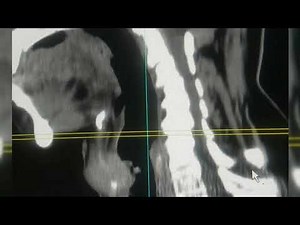 CT scan of neck -Laryngeal Carcinoma