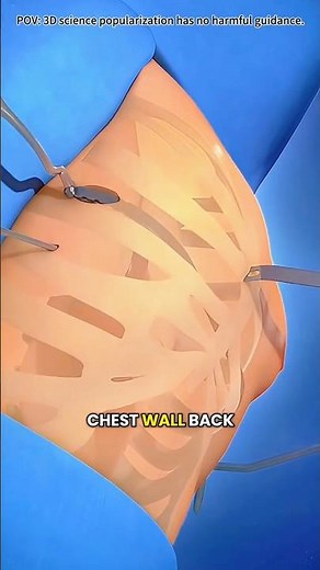 Nuss Procedure for Pectus Excavatum | Chest Surgery 3D Animation Explained #shorts