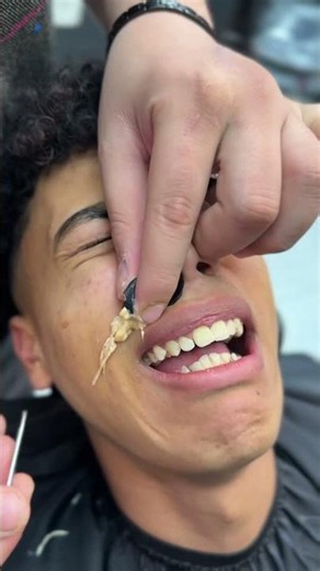 The removal of the blackhead from the face😳✂️#fyp #foryou #foryoupage #viral #explore #comedy #asmr