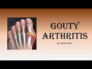 [Rheumatology] Gouty arthritis/gout - signs and symptoms, investigation, treatment