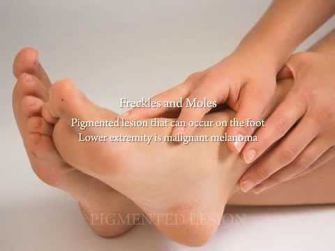 Common Cancers of the Foot (Melanomas)