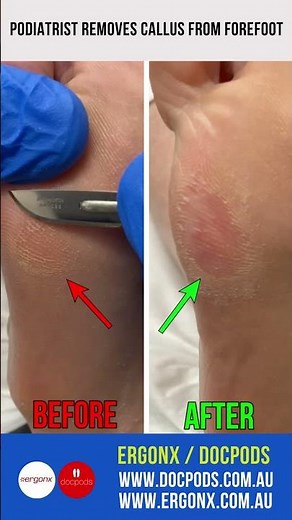 Callus removal from foot