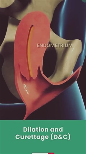 D and C procedure E and C