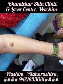 Giant Polyp (Fibroepithelial) surgery